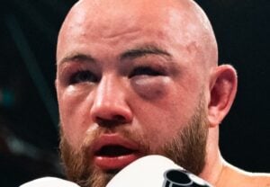 Kownacki Suffered Fractured Left Orbital Bone In First Round; Exploring Surgery Options